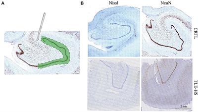 iTRAQ-Based Proteomic Analysis of Dentate Gyrus in Temporal Lobe Epilepsy With Hippocampal Sclerosis